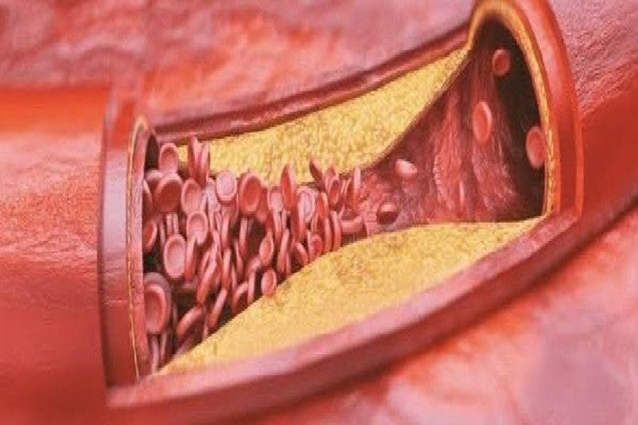 Cholesterol levels predict dementia