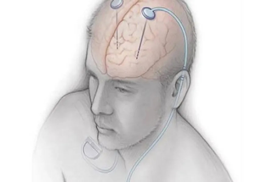 Parkinson’s research advances with magnetic technique to reconnect neurons