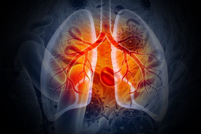 Study reveals shocking link between diet and lung cancer risk
