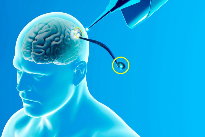 Breakthrough brain implant offers new voice for speechless